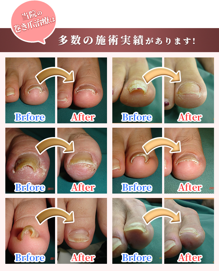 当院の巻き爪治療は多数の施術実績があります。